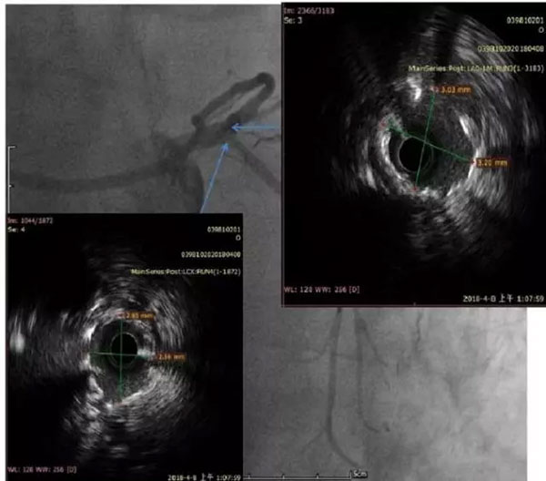 һҽԺԺڿŶӳɹչIVUSָPCI